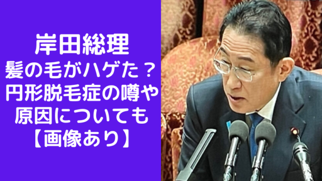 【画像】岸田総理の髪の毛がハゲた？円形脱毛症の噂や原因についても